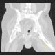 Gangrene of perineum and ischiorectal fossa, Fournier gangrene: CT - Computed tomography
