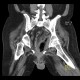 Gangrene of perineum and ischiorectal fossa, Fournier gangrene: CT - Computed tomography