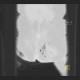 Gangrene of perineum and ischiorectal fossa, Fournier gangrene: CT - Computed tomography