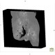Gangrene of perineum and ischiorectal fossa, Fournier gangrene: CT - Computed tomography
