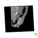 Gangrene of perineum and ischiorectal fossa, Fournier gangrene: CT - Computed tomography
