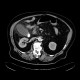 Phlegmonous cholecystitis, cholecystitis, gallstone, cholecystolithiasis: CT - Computed tomography