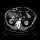 Phlegmonous cholecystitis, cholecystitis, gallstone, cholecystolithiasis: CT - Computed tomography