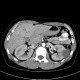 Focal nodular hyperplasia, FNH, flow rate of contrast: CT - Computed tomography