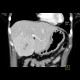 Focal nodular hyperplasia, FNH, flow rate of contrast: CT - Computed tomography