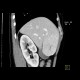 Focal nodular hyperplasia, FNH, flow rate of contrast: CT - Computed tomography