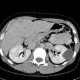 Focal nodular hyperplasia, FNH, flow rate of contrast: CT - Computed tomography