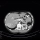 Focal nodular hyperplasia, liver: CT - Computed tomography