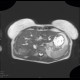 Focal nodular hyperplasia, liver, T2W: MRI - Magnetic Resonance Imaging