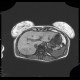 Focal nodular hyperplasia, liver, T1W native: MRI - Magnetic Resonance Imaging
