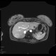 Focal nodular hyperplasia, liver, T1W arterial phase: MRI - Magnetic Resonance Imaging