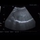 Focal nodular hyperplasia, liver: US - Ultrasound