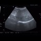 Focal nodular hyperplasia, liver: US - Ultrasound