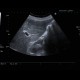 Focal nodular hyperplasia, FNH: US - Ultrasound