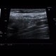 Appendix, normal appearance: US - Ultrasound