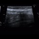 Appendix, normal appearance: US - Ultrasound