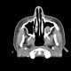 Dentigenous cyst in maxillary sinus: CT - Computed tomography