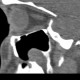 Dentigenous cyst in maxillary sinus: CT - Computed tomography