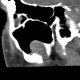 Dentigenous cyst in maxillary sinus: CT - Computed tomography