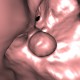 Dentigenous cyst in maxillary sinus, VE: CT - Computed tomography