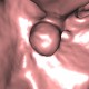 Dentigenous cyst in maxillary sinus, VE: CT - Computed tomography