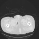 Fournier gangrene: CT - Computed tomography