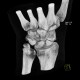 Fracture of scaphoid bone, dislocation of pisiform bone, abruption of lunate: CT - Computed tomography
