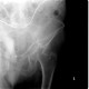 Comminuted fracture of acetabulum and pubic bone, central dislocation of femoral head: X-ray - Plain radiograph