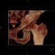 Comminuted fracture of acetabulum and pubic bone, central dislocation of femoral head: CT - Computed tomography