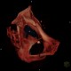 Comminuted fracture of acetabulum and pubic bone, central dislocation of femoral head: CT - Computed tomography