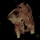 Fracture of pelvis, iliac wing, VRT: CT - Computed tomography