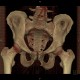 Fracture of pelvis, iliac wing, VRT: CT - Computed tomography
