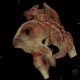 Fracture of pelvis, iliac wing, VRT: CT - Computed tomography
