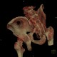 Fracture of pelvis, iliac wing, VRT: CT - Computed tomography