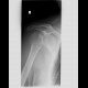 Comminuted fracture of the head of humerus: X-ray - Plain radiograph