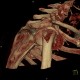 Comminuted fracture of the head of humerus, VRT: CT - Computed tomography