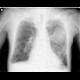 Rib fracture, lung contusion, hematoma, pneumothorax, hydropneumothorax: X-ray - Plain radiograph