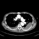 Rib fracture, lung contusion, hematoma, pneumothorax, hydropneumothorax: CT - Computed tomography