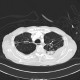 Rib fracture, lung contusion, hematoma, pneumothorax, hydropneumothorax: CT - Computed tomography