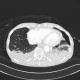 Rib fracture, lung contusion, hematoma, pneumothorax, hydropneumothorax: CT - Computed tomography