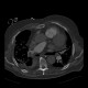 Rib fractures after resuscitation: CT - Computed tomography