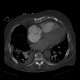 Rib fractures after resuscitation: CT - Computed tomography