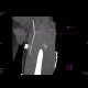Active bleeding in the thigh: CT - Computed tomography