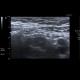 Fetal orifice of appendix: US - Ultrasound