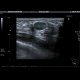 Fibroadenoma of breast: US - Ultrasound