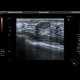Fibroadenoma of breast: US - Ultrasound
