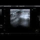 Fibroadenoma of breast: US - Ultrasound