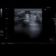 Fibroadenoma of breast: US - Ultrasound