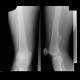 Fibrocartilaginous exostosis: X-ray - Plain radiograph