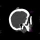 Fibroma, subcutaneous: CT - Computed tomography